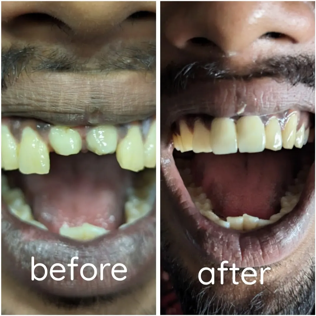 Aesthetic zirconia crowns smile transformation