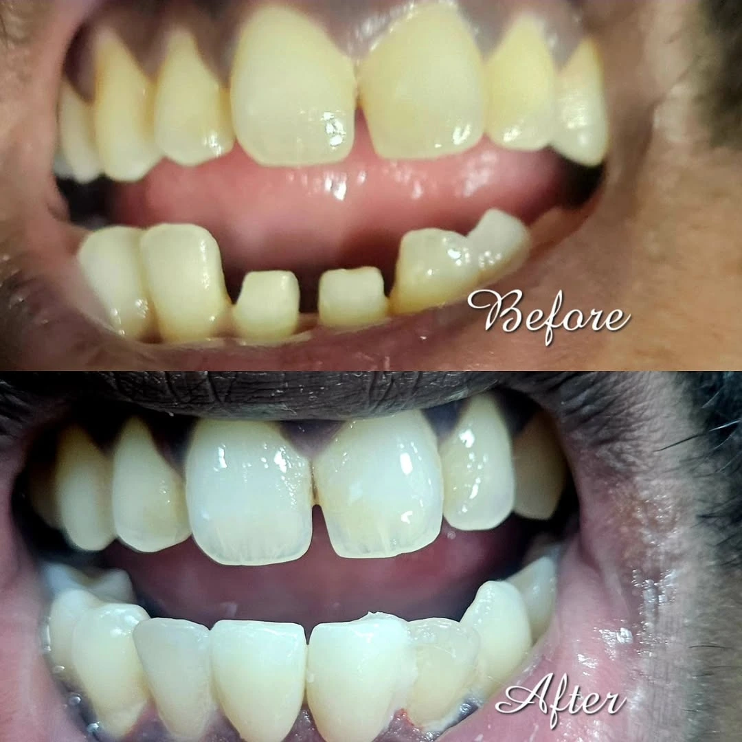 Dental restoration options for missing teeth