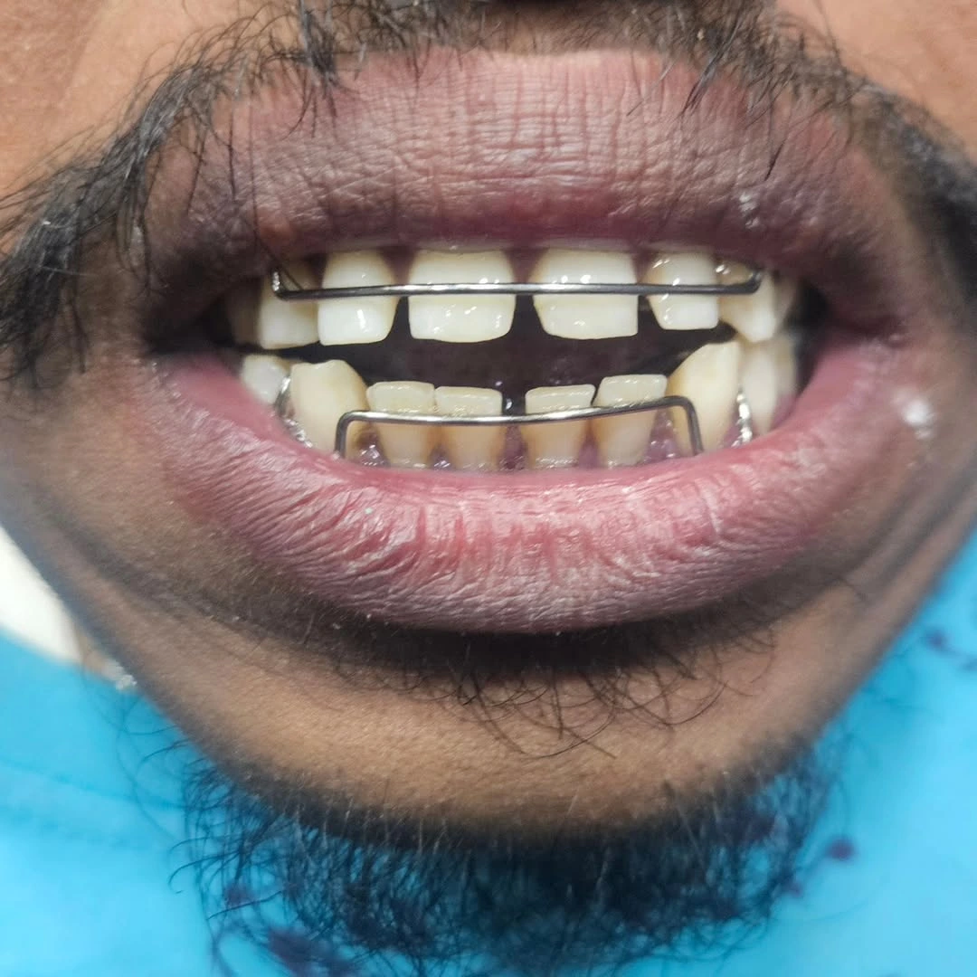 Hawleys removable orthodontic appliance