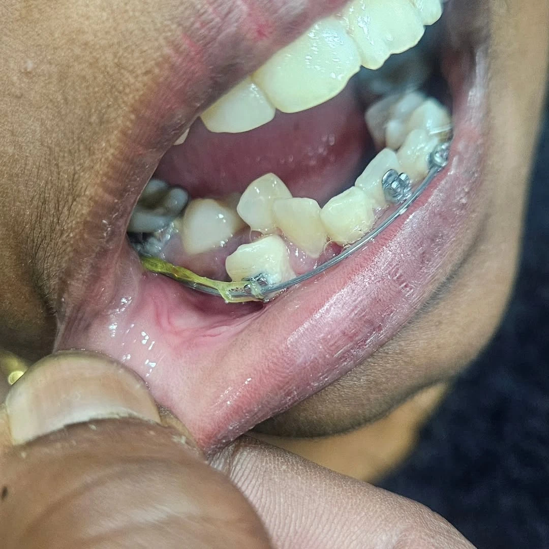 Orthodontic braces lower jaw