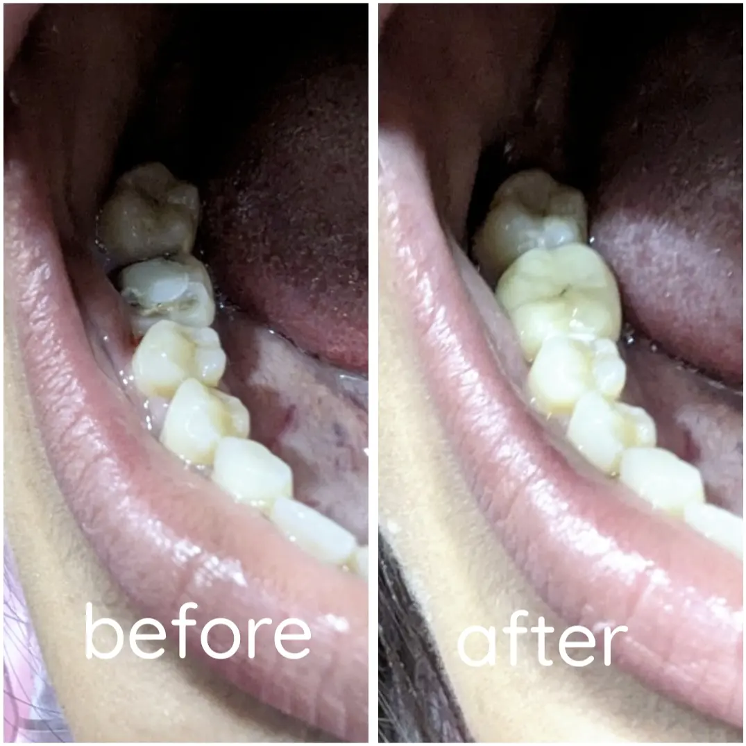 Molar zirconia crown restoration