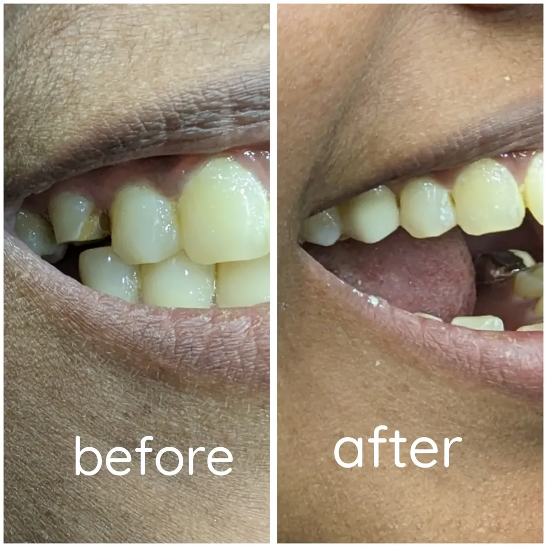 Single tooth zirconia crown result