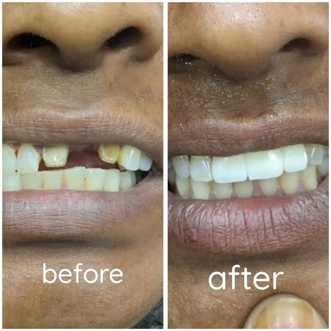 Three unit zirconia dental bridge