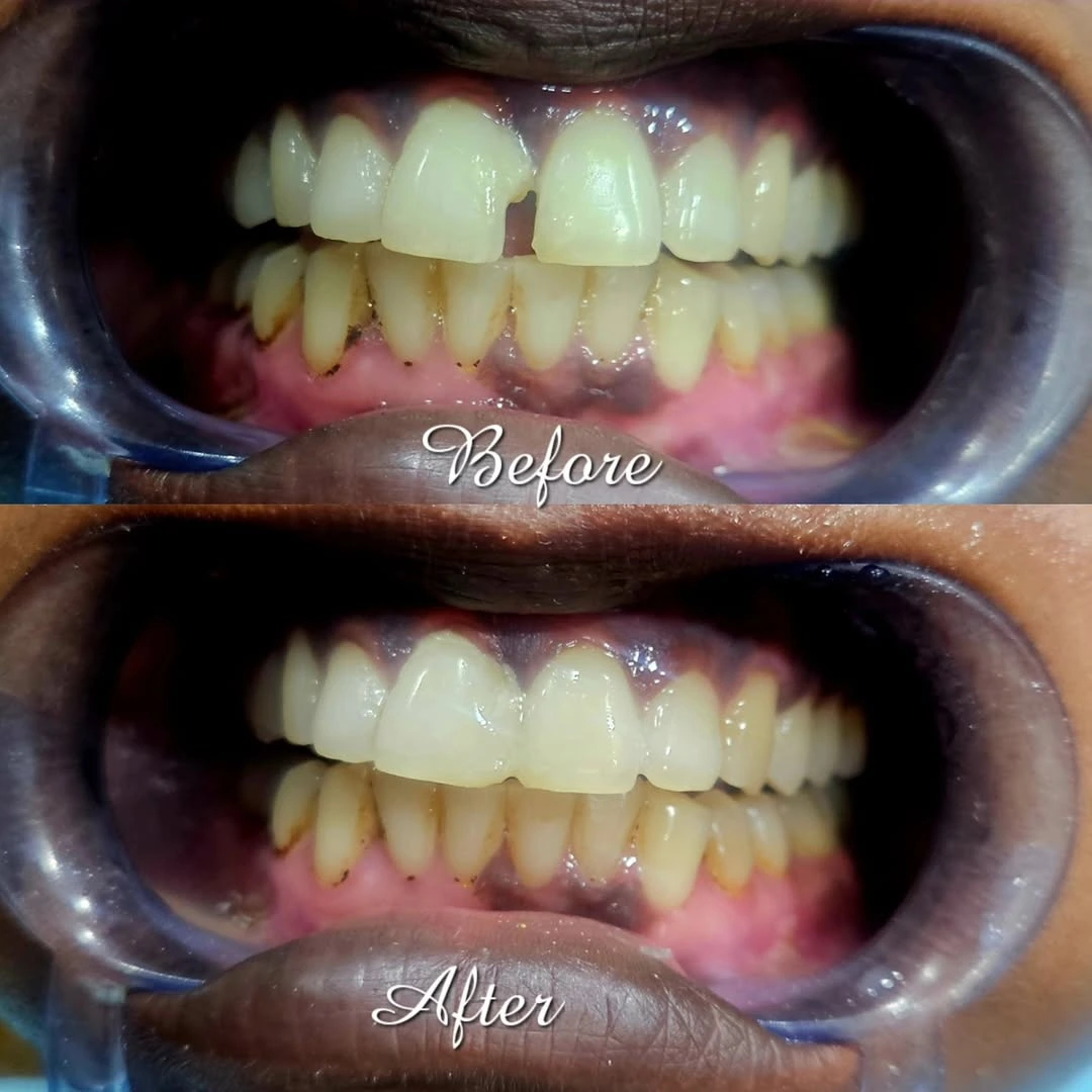 Before and after smile result 13