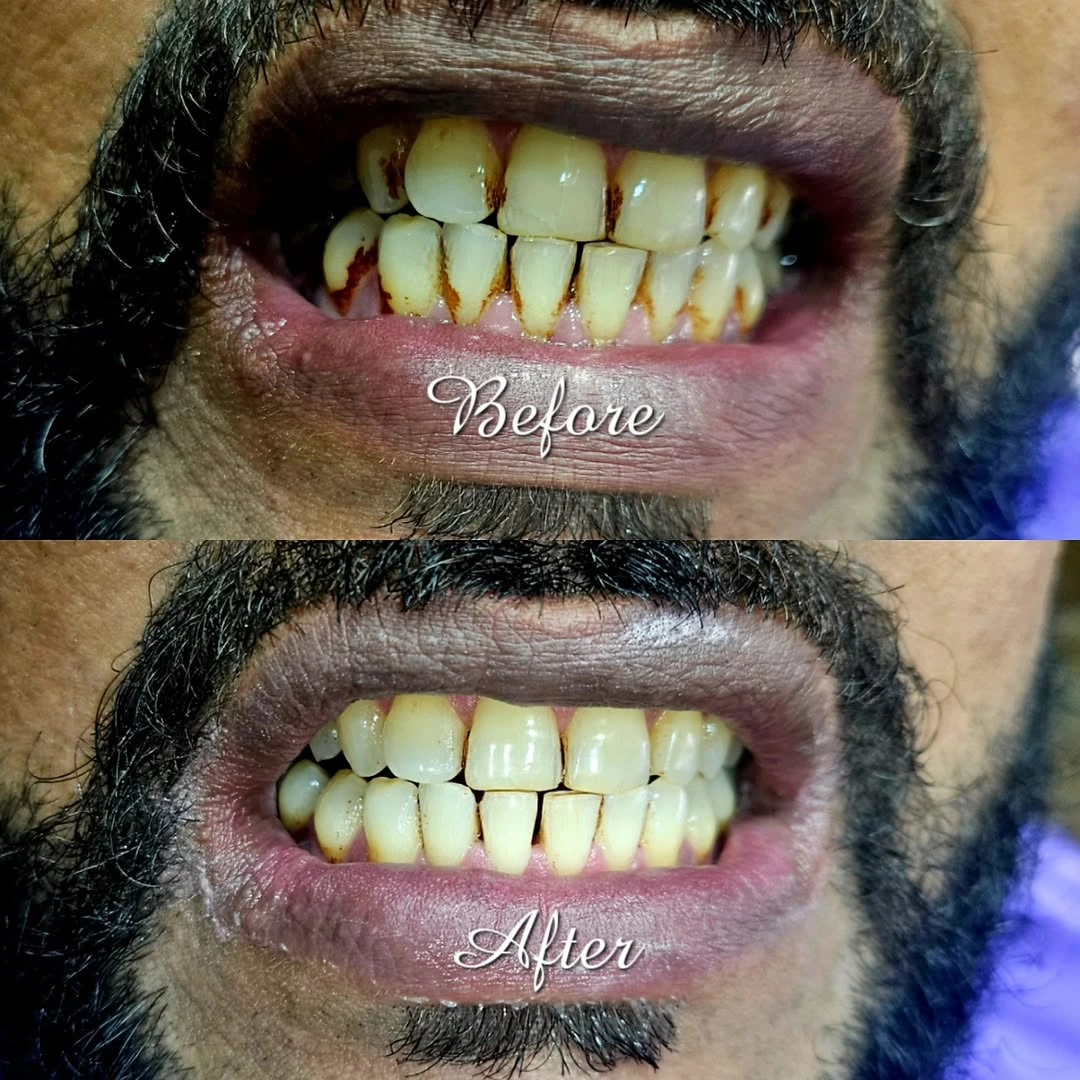 Before and after smile result 14