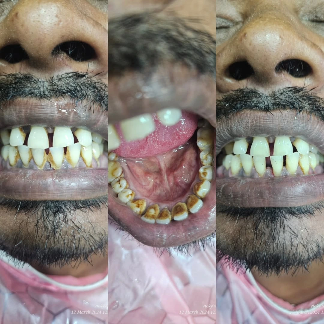 Before and after smile result 15