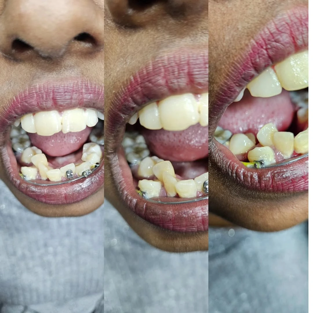 Before and after smile result 16