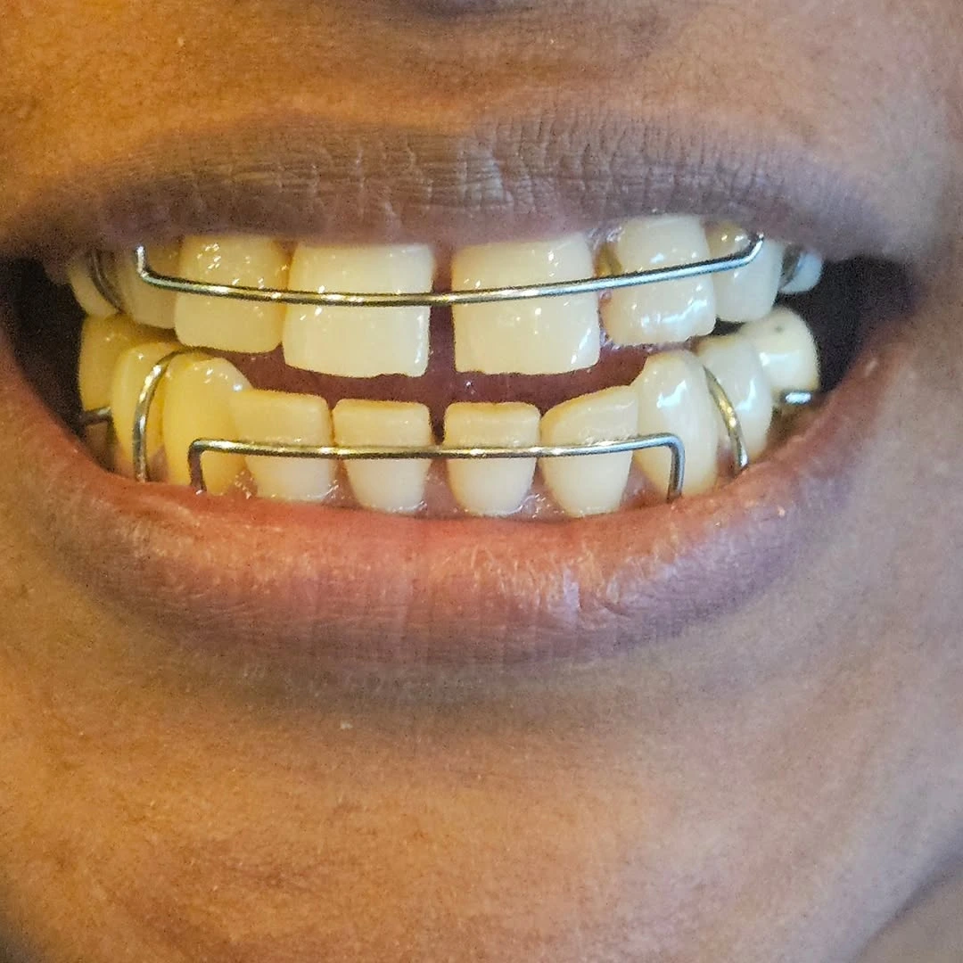 Dental Implant Specialist Kodaikanal
