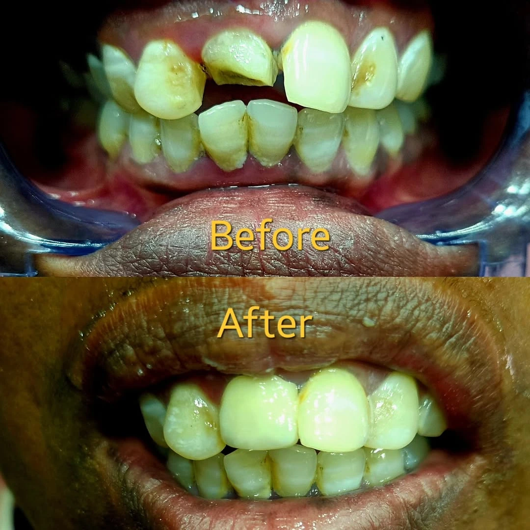 Before and after smile result 18