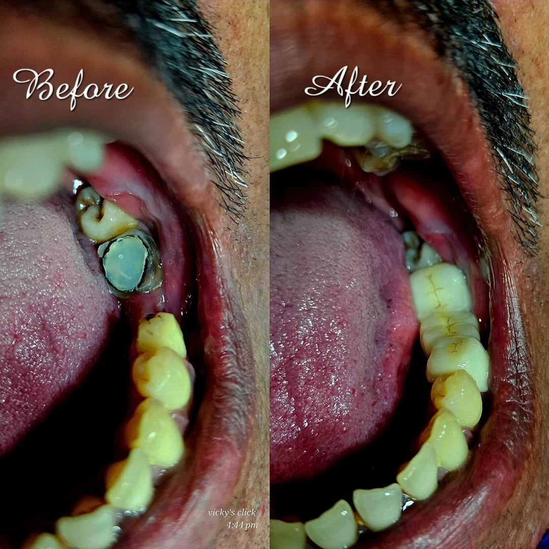 Before and after smile result 22