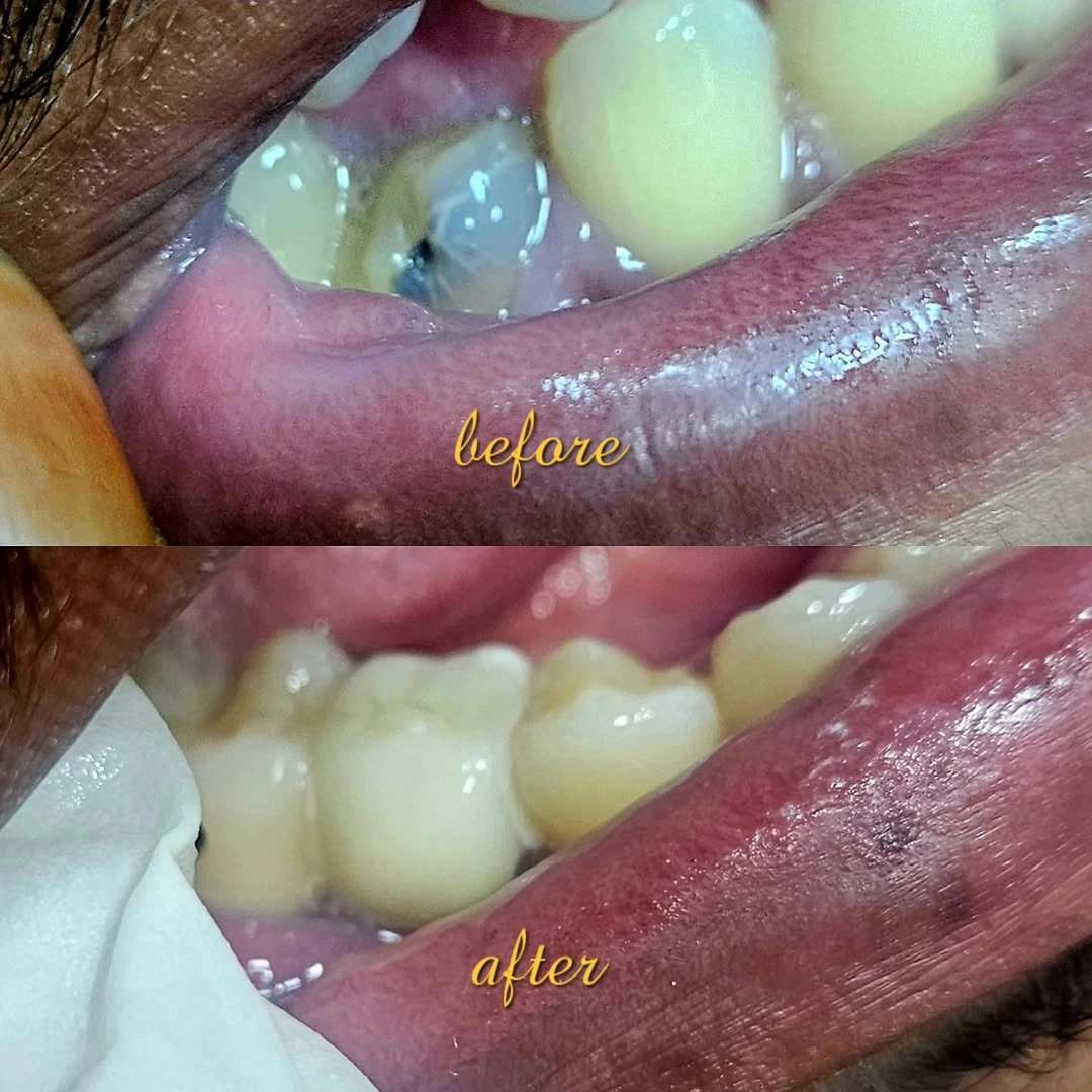 Before and after smile result 23