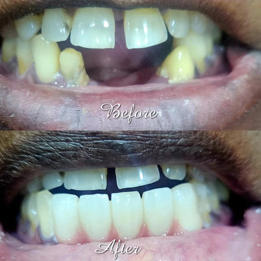 Dental Tourism India Kodaikanal