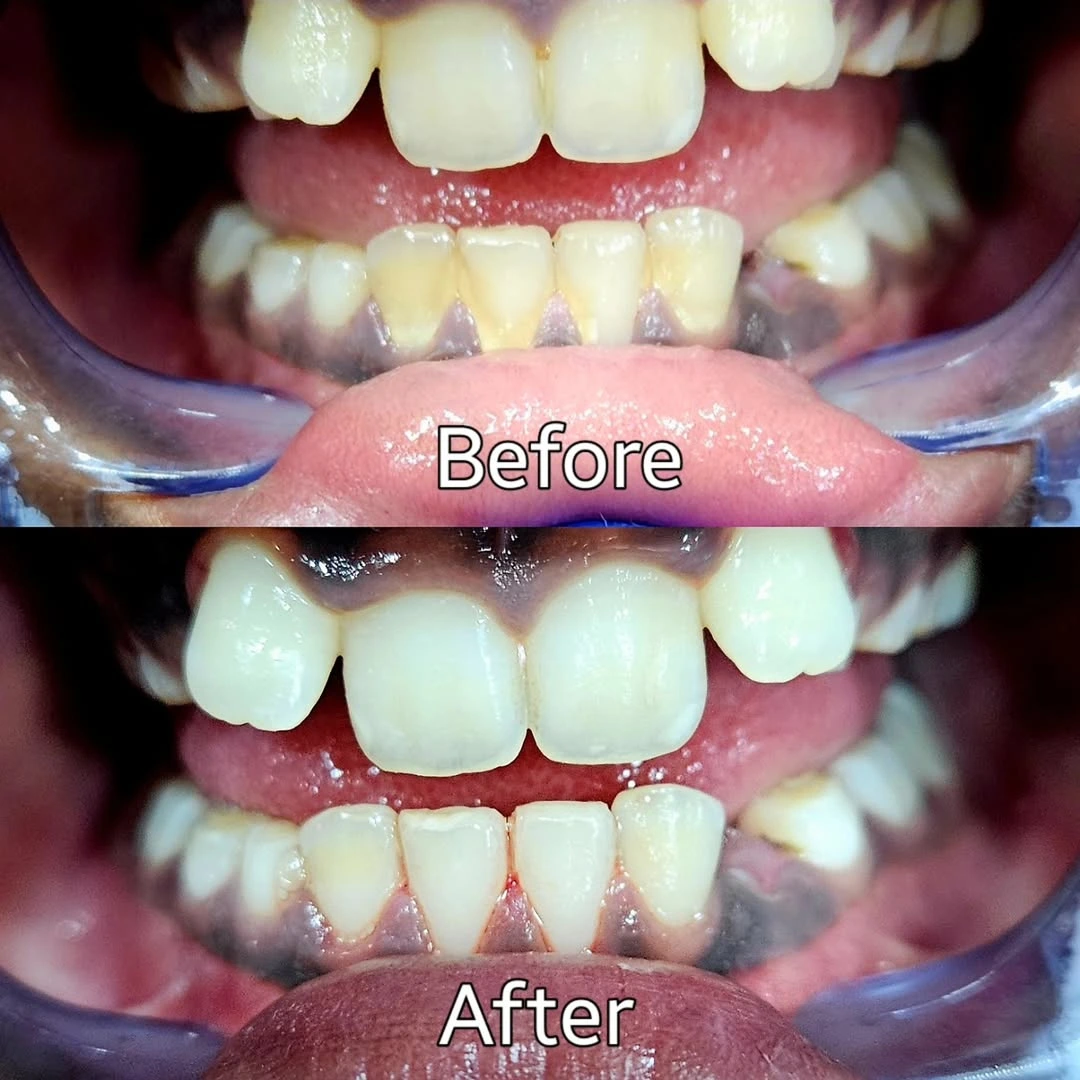 Before and after smile result 27