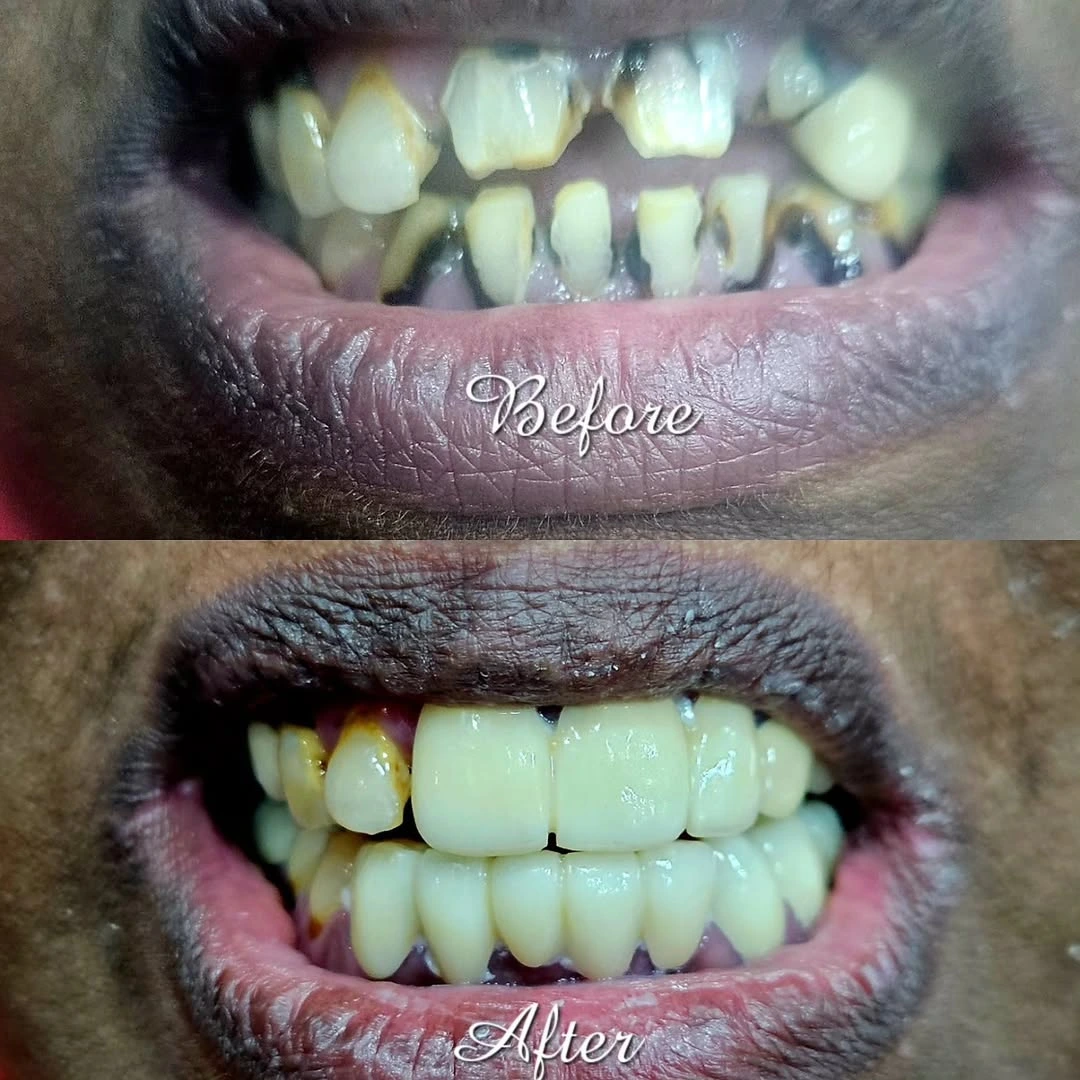 Before and after smile result 29