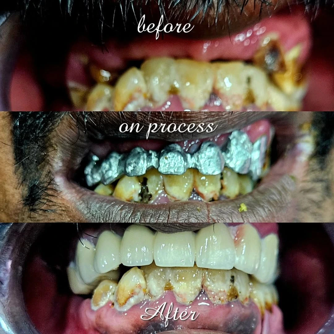 Before and after smile result 30