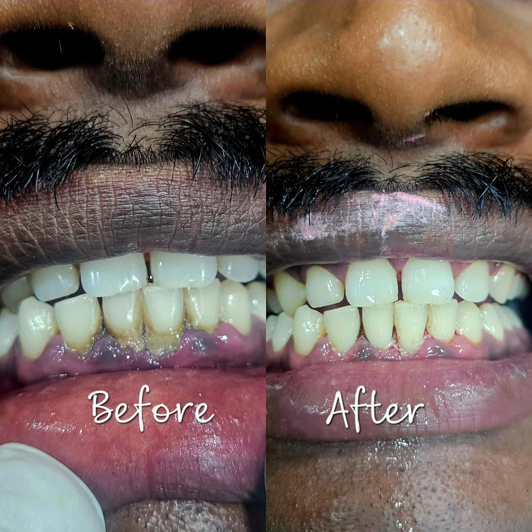 Before and after smile result 32