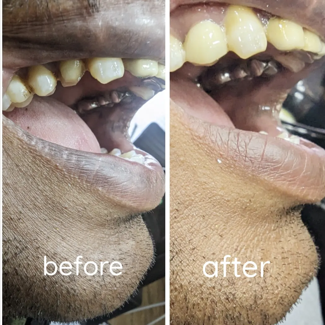Zirconia dental crown placement result